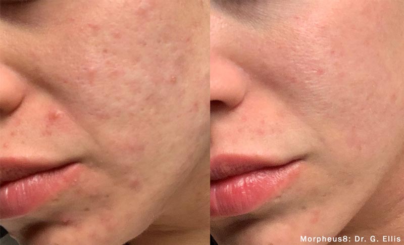 before and after morpheus8
