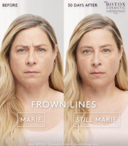 Before and After capture of frown lines from NuWave Medical, a health and wellness center